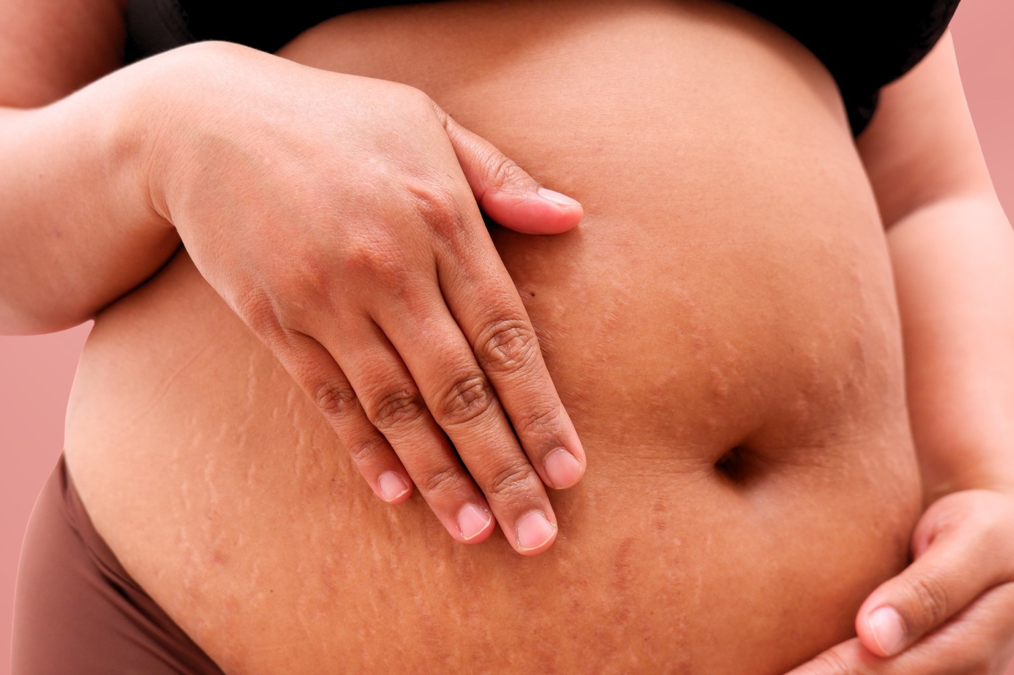 Meta-analysis finds no clear rise in birth defects after GLP-1 exposure