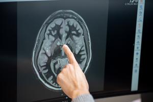 Brain recordings suggest tirzepatide's effect on food noise may be temporary