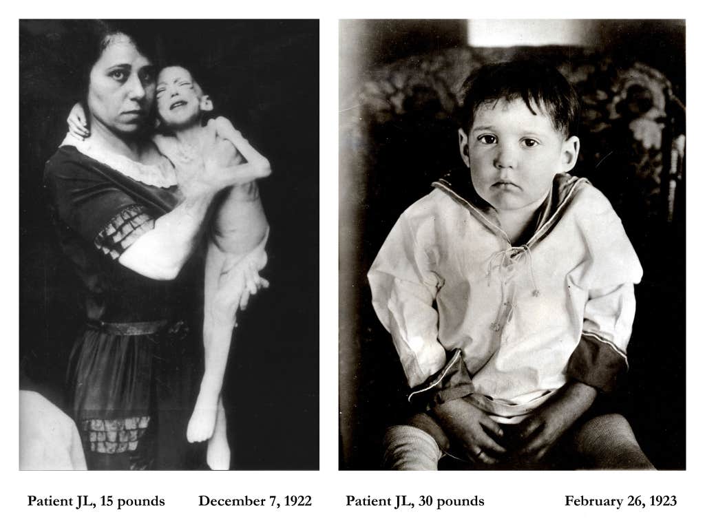 1923 before and after photos of a patient after treatment from the world's first commercially available insulin product