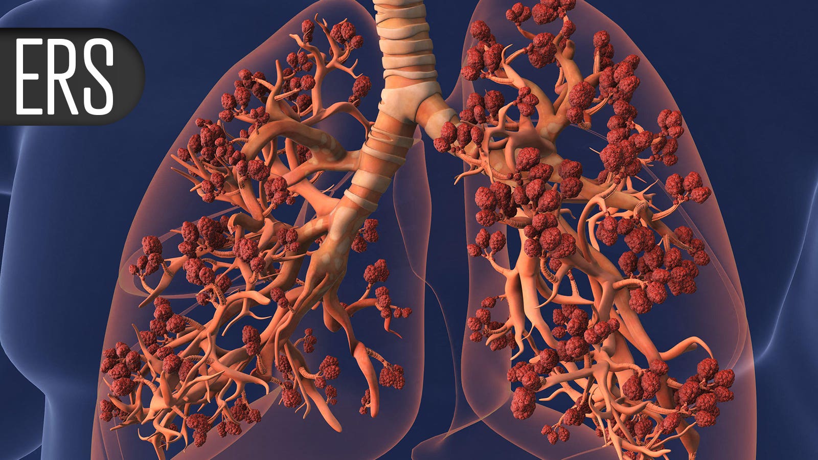 ERS 2026: semaglutide tied to about 40 percent fewer asthma attacks
