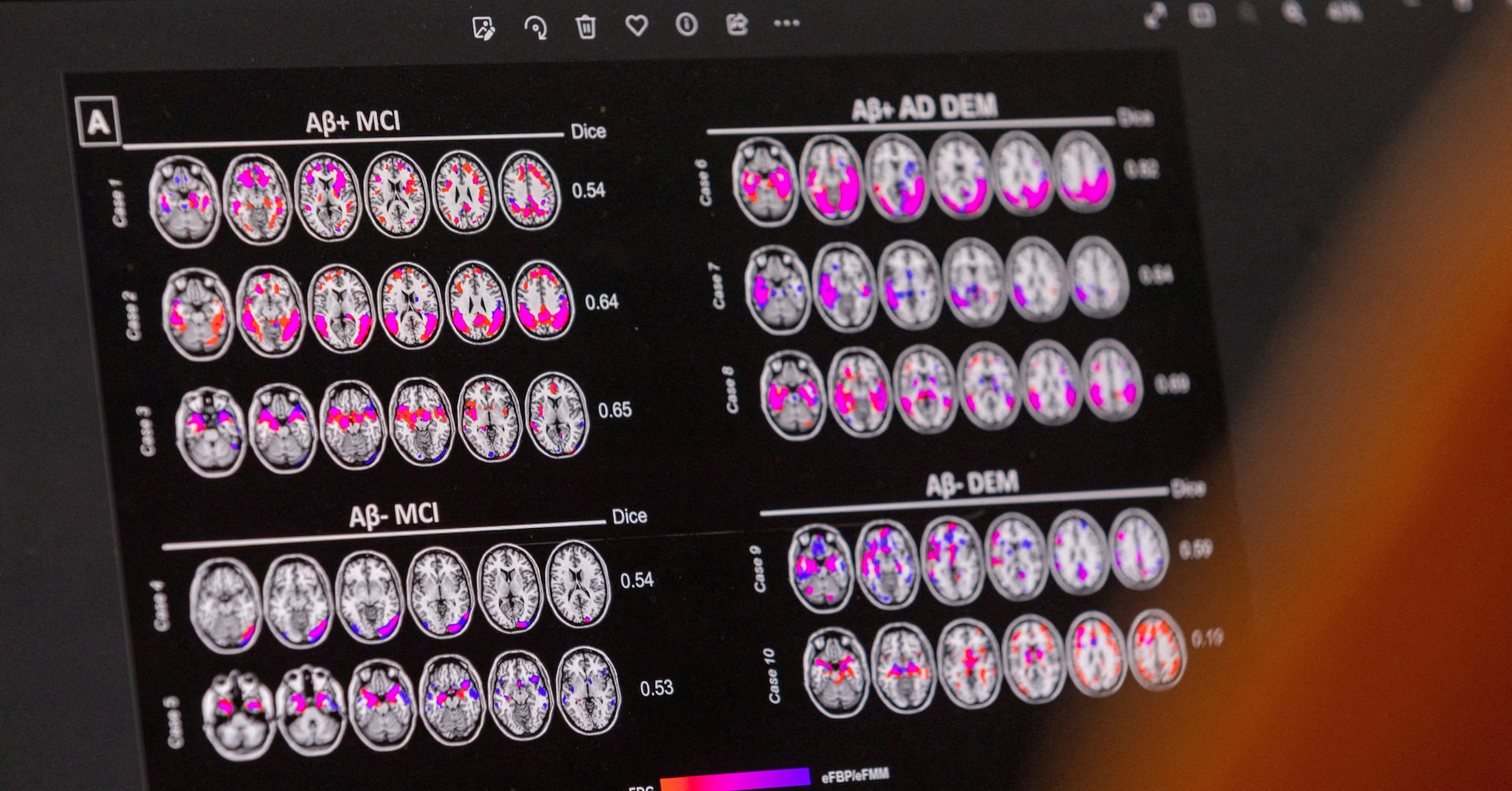 EVOKE and EVOKE+ fail: semaglutide does not slow Alzheimer's disease