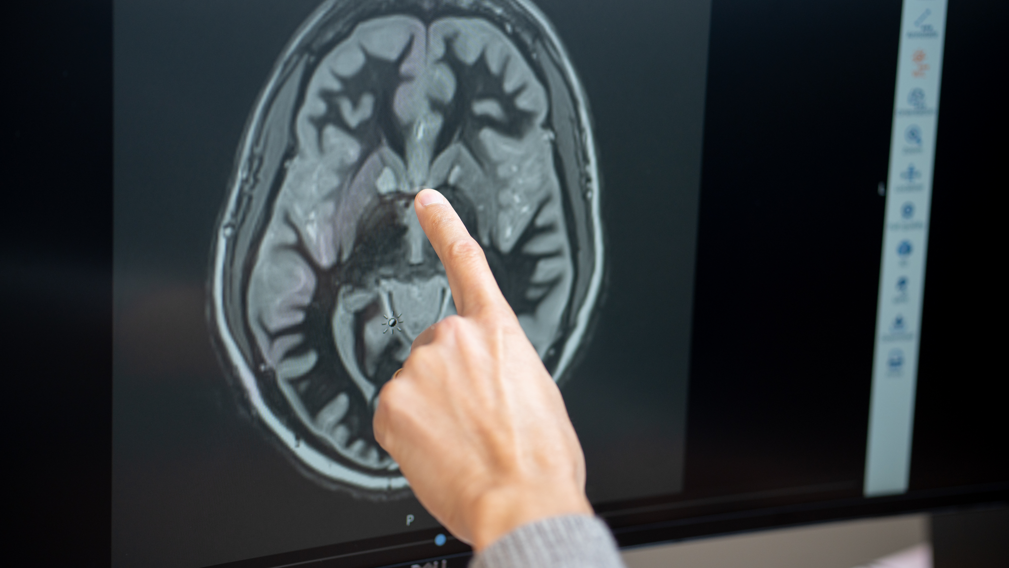 Brain recordings suggest tirzepatide's effect on food noise may be temporary